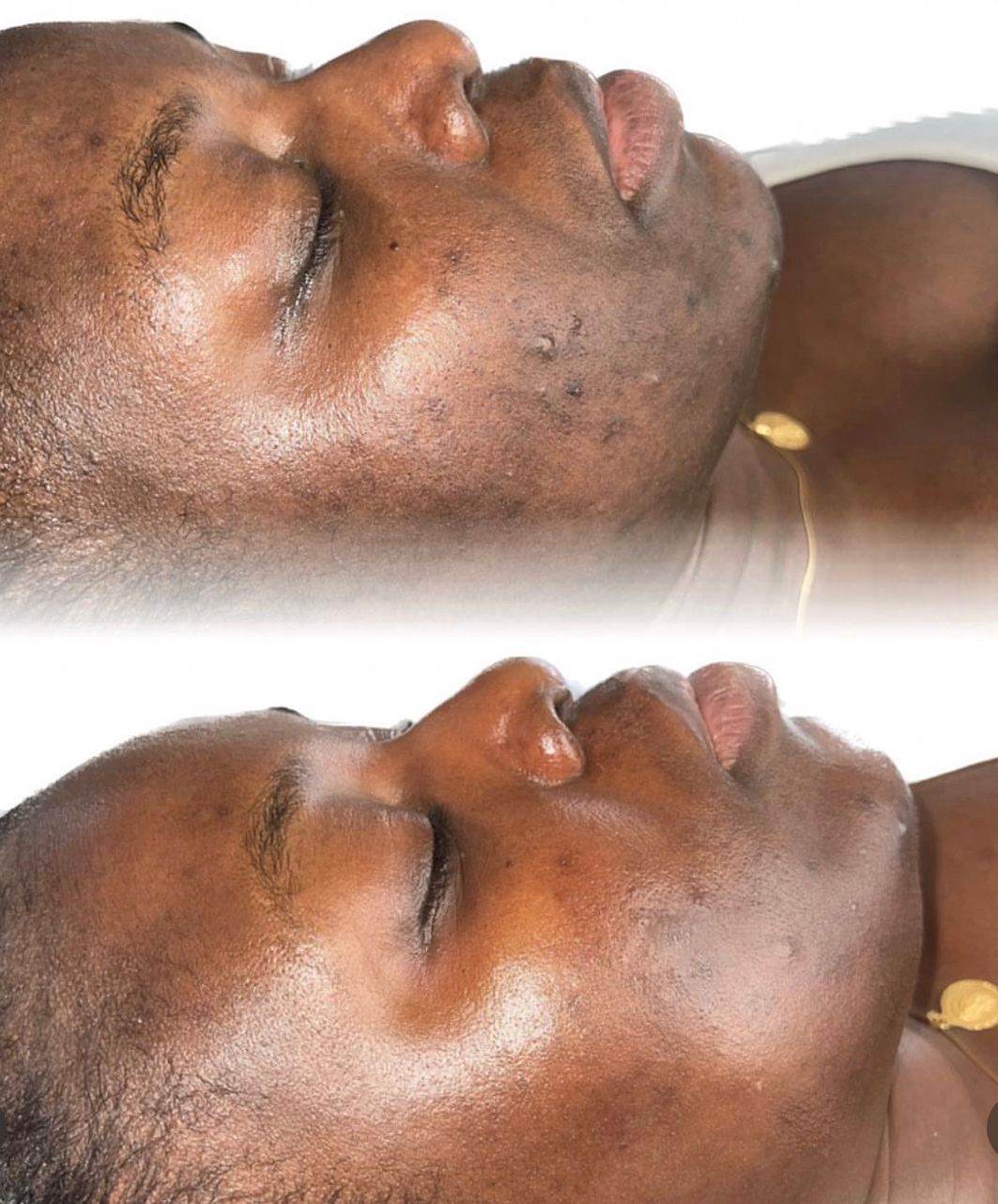 Microdermabrasion Facial - Course